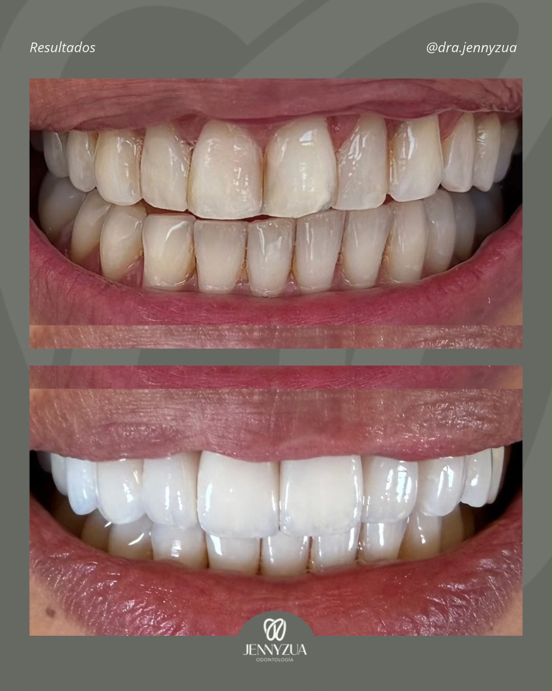 Antes y después de un diseño de sonrisa realizado en JennyZua Odontología